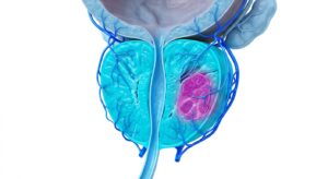 3D medical illustration of the prostate gland with a highlighted tumor area on a pure white background
