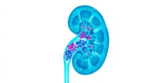3D medical illustration of urinary stones in a human kidney